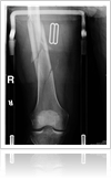 Bone xray-1000-ffccccccWhite-3333-0.20.3-1