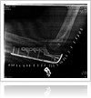 Broken bone-1000-ffccccccWhite-3333-0.20.3-1 Los Angeles Auto Accident Attorney