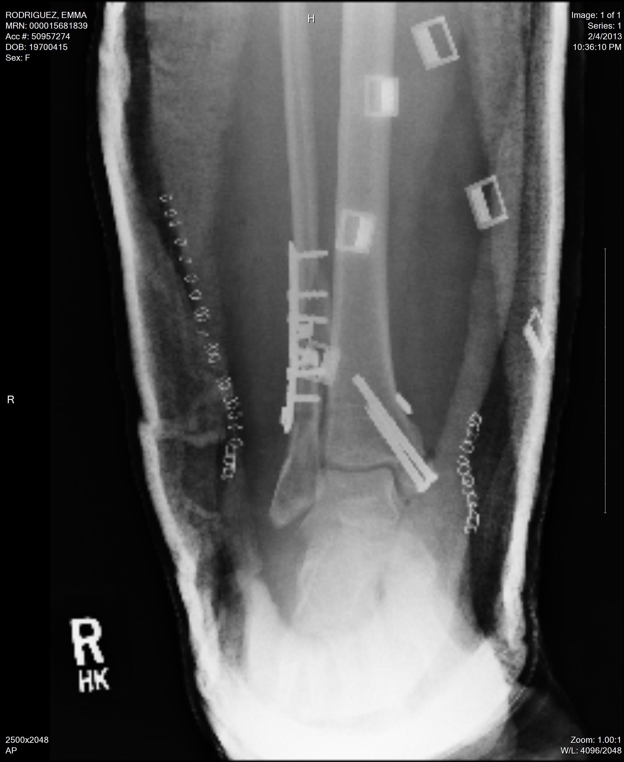 right ankle with screws